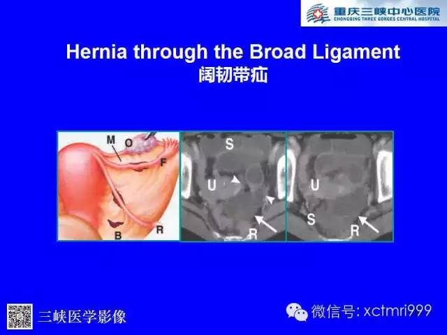 【PPT】腹内疝的影像诊断