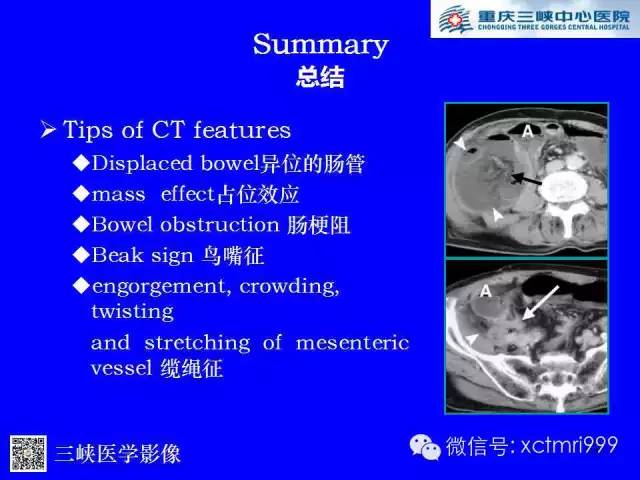 【PPT】腹内疝的影像诊断