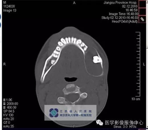 【病例】下颌骨含牙囊肿1例CT影像表现