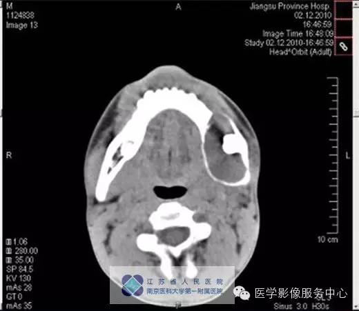 【病例】下颌骨含牙囊肿1例CT影像表现 【病例】下颌骨含牙囊肿1例CT影像表现