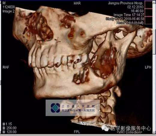 【病例】下颌骨含牙囊肿1例CT影像表现 【病例】下颌骨含牙囊肿1例CT影像表现