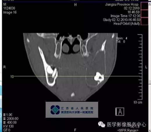 【病例】下颌骨含牙囊肿1例CT影像表现 【病例】下颌骨含牙囊肿1例CT影像表现