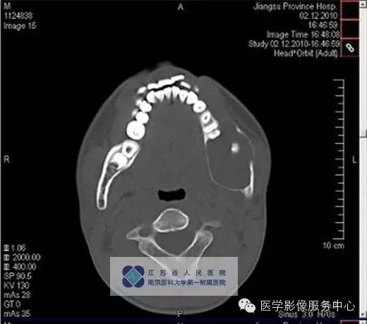 【病例】下颌骨含牙囊肿1例CT影像表现 【病例】下颌骨含牙囊肿1例CT影像表现