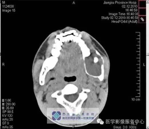 【病例】下颌骨含牙囊肿1例CT影像表现 【病例】下颌骨含牙囊肿1例CT影像表现