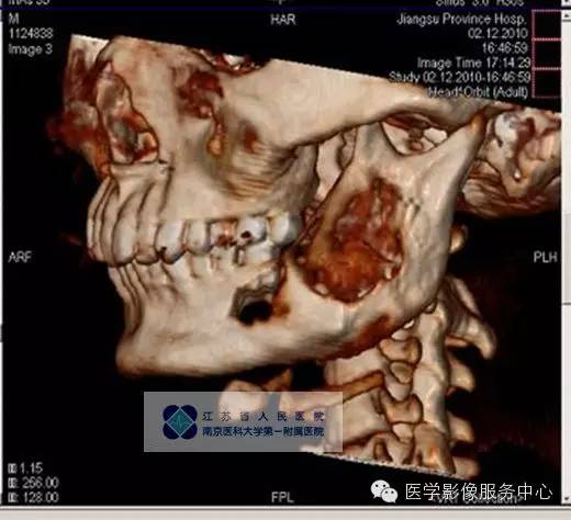 【病例】下颌骨含牙囊肿1例CT影像表现 【病例】下颌骨含牙囊肿1例CT影像表现