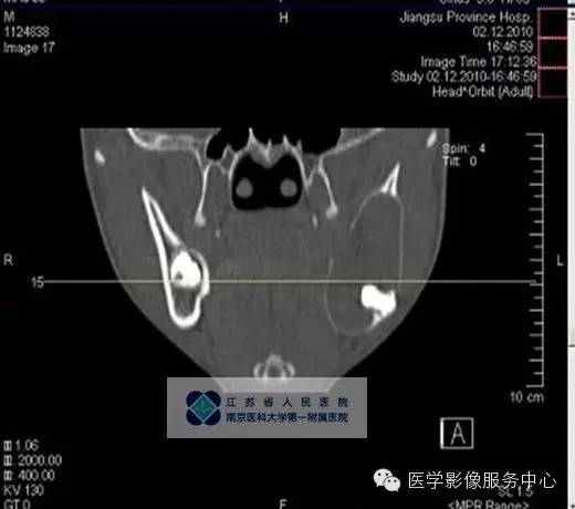 【病例】下颌骨含牙囊肿1例CT影像表现 【病例】下颌骨含牙囊肿1例CT影像表现