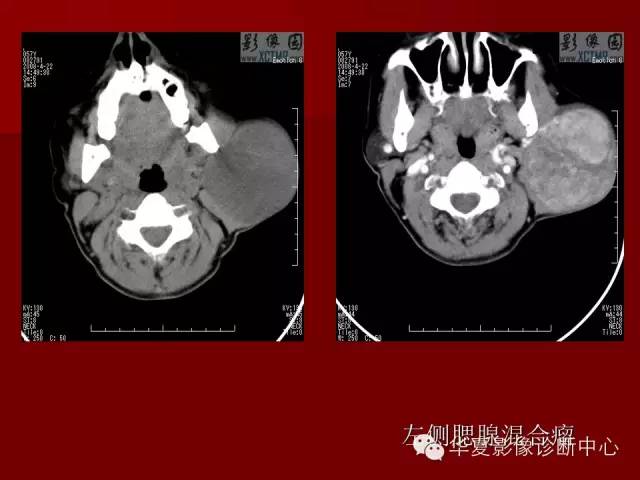 【PPT】涎腺常见肿瘤的CT诊断