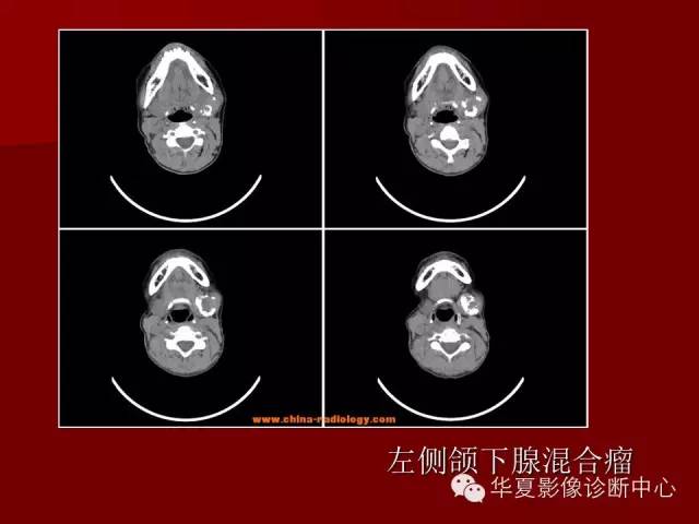 【PPT】涎腺常见肿瘤的CT诊断