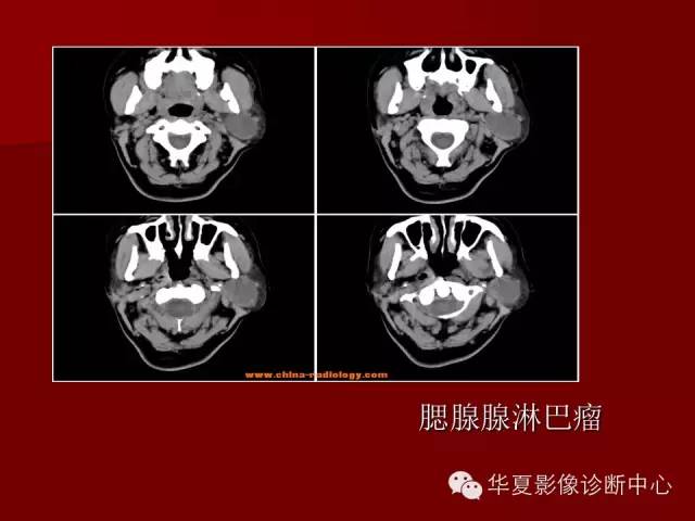 【PPT】涎腺常见肿瘤的CT诊断