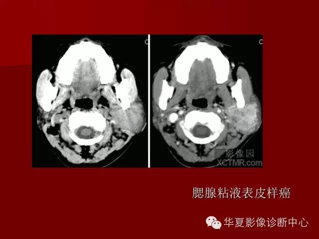 【PPT】涎腺常见肿瘤的CT诊断