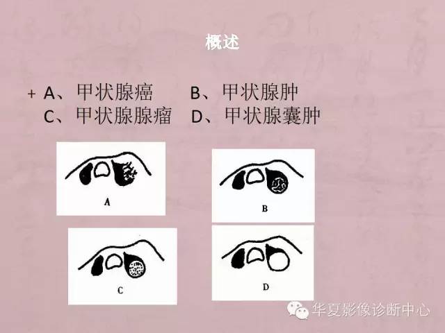 【PPT】甲状腺疾病CT简述