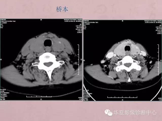 【PPT】甲状腺疾病CT简述