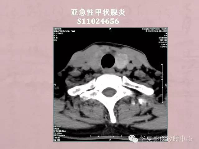 【PPT】甲状腺疾病CT简述