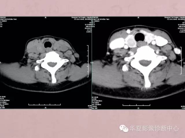 【PPT】甲状腺疾病CT简述