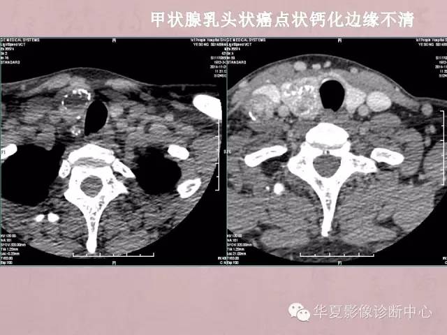 【PPT】甲状腺疾病CT简述