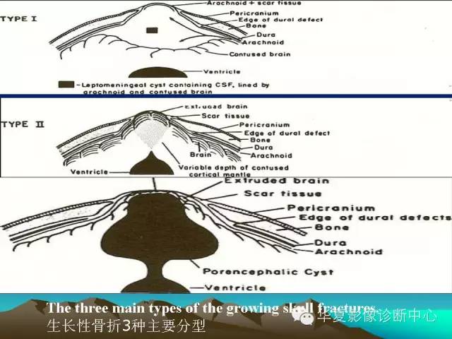 【PPT】颅骨生长性骨折的影像诊断
