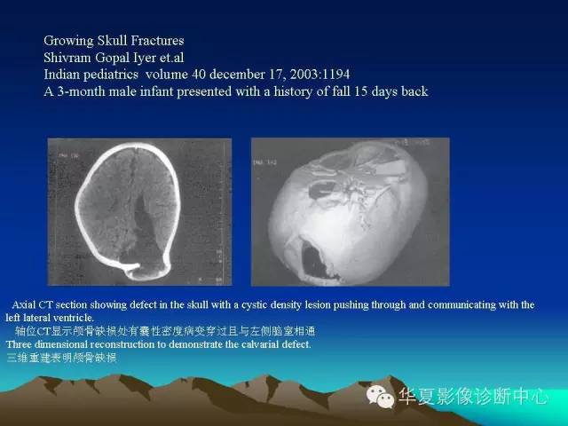 【PPT】颅骨生长性骨折的影像诊断