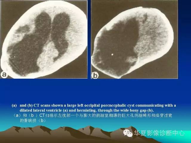 【PPT】颅骨生长性骨折的影像诊断