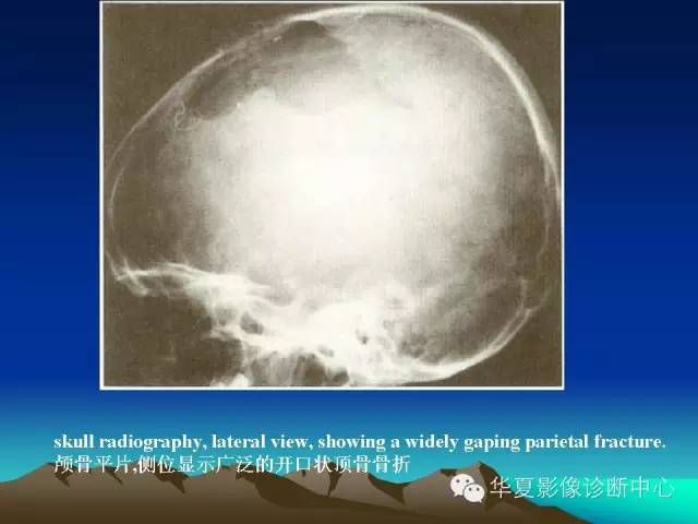 【PPT】颅骨生长性骨折的影像诊断