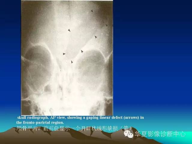 【PPT】颅骨生长性骨折的影像诊断