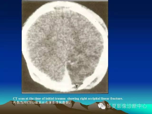 【PPT】颅骨生长性骨折的影像诊断