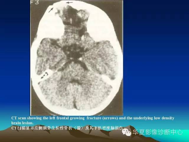 【PPT】颅骨生长性骨折的影像诊断