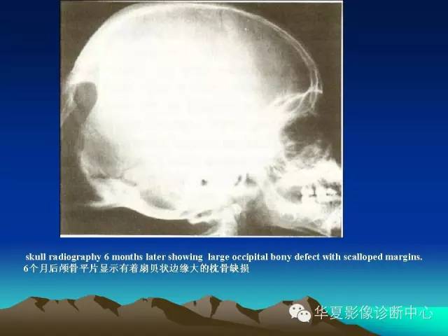 【PPT】颅骨生长性骨折的影像诊断