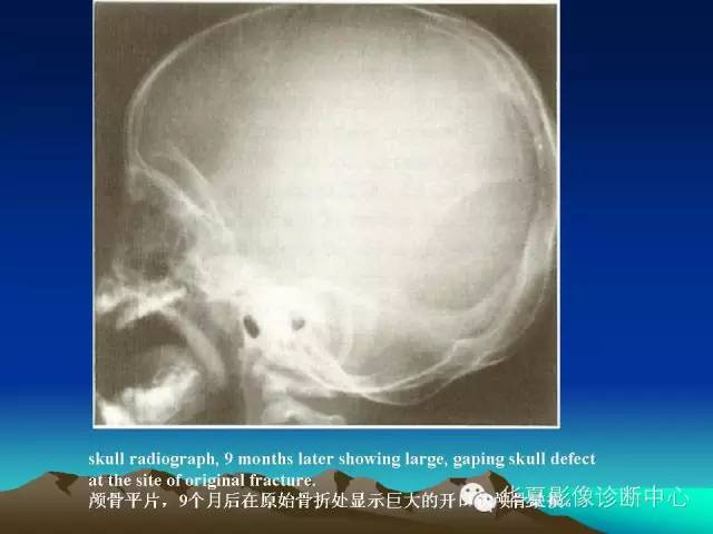 【PPT】颅骨生长性骨折的影像诊断
