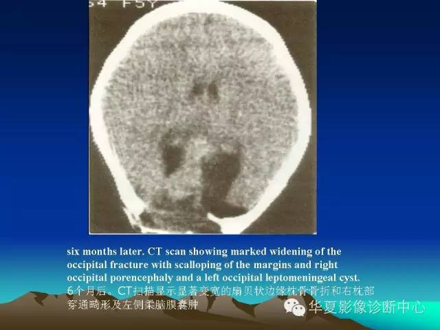 【PPT】颅骨生长性骨折的影像诊断