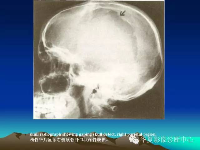 【PPT】颅骨生长性骨折的影像诊断