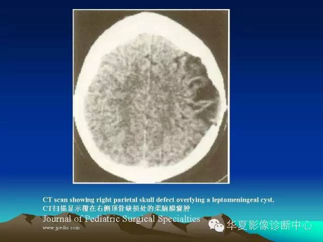 【PPT】颅骨生长性骨折的影像诊断