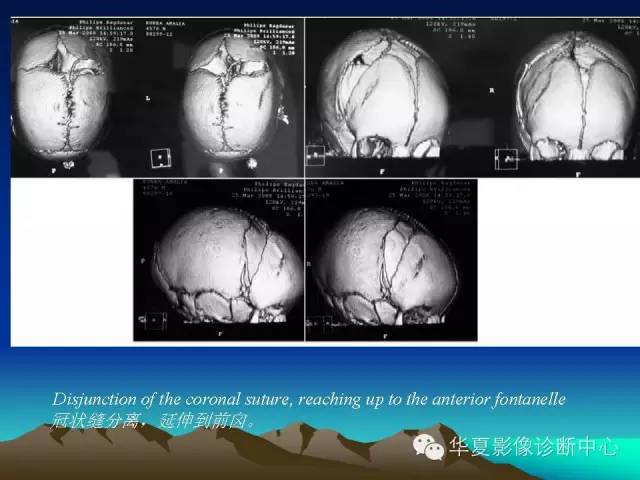 【PPT】颅骨生长性骨折的影像诊断
