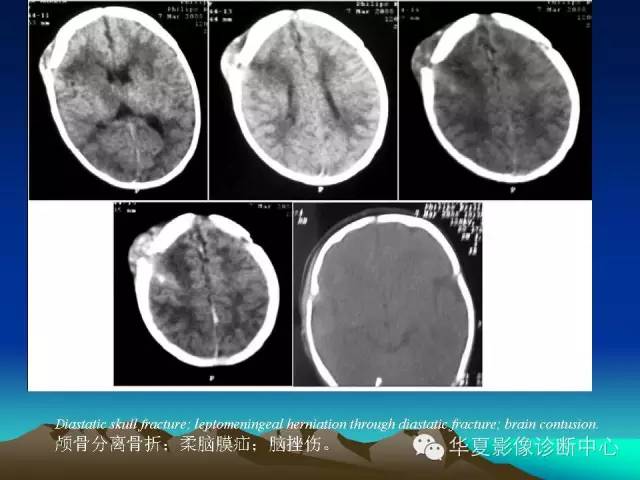 【PPT】颅骨生长性骨折的影像诊断