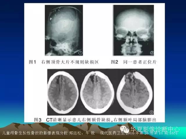 【PPT】颅骨生长性骨折的影像诊断