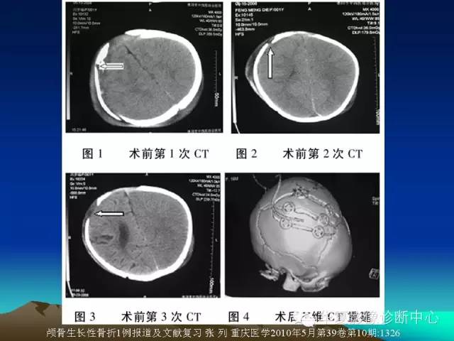 【PPT】颅骨生长性骨折的影像诊断