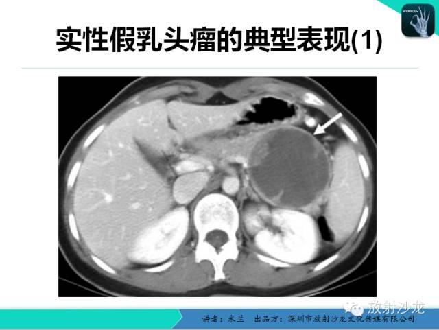 【PPT】少女瘤-胰腺实性-假乳头状瘤