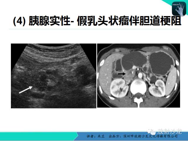 【PPT】少女瘤-胰腺实性-假乳头状瘤