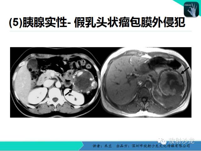 【PPT】少女瘤-胰腺实性-假乳头状瘤