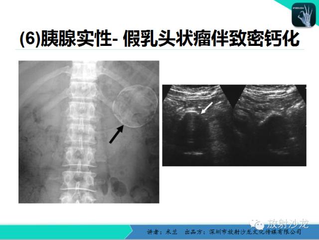 【PPT】少女瘤-胰腺实性-假乳头状瘤