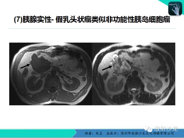 【PPT】少女瘤-胰腺实性-假乳头状瘤