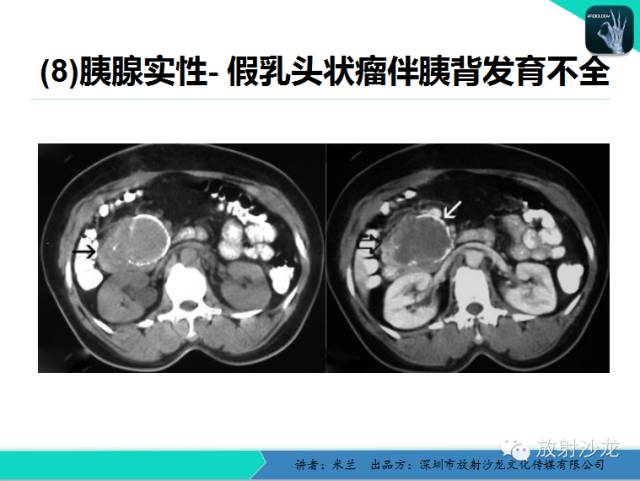 【PPT】少女瘤-胰腺实性-假乳头状瘤