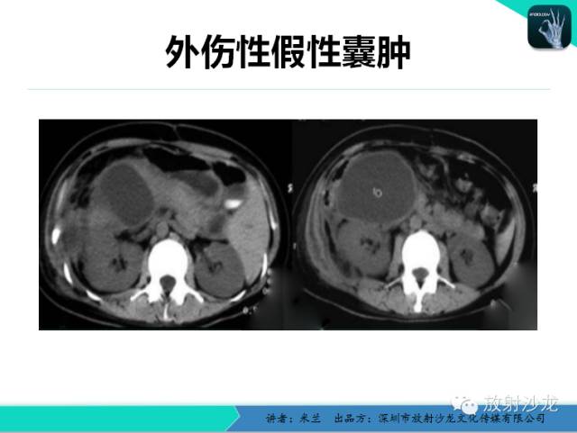 【PPT】少女瘤-胰腺实性-假乳头状瘤
