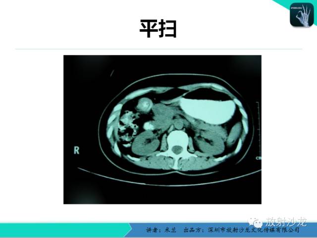 【PPT】少女瘤-胰腺实性-假乳头状瘤