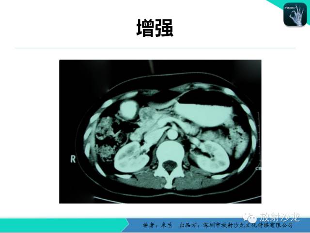 【PPT】少女瘤-胰腺实性-假乳头状瘤