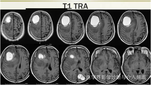 【病例】颅内转移瘤1例MR影像表现