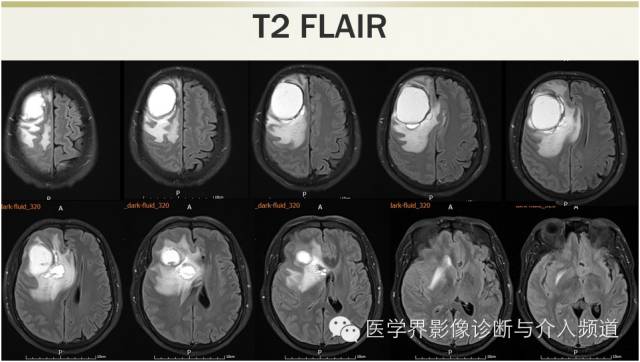 【病例】颅内转移瘤1例MR影像表现 【病例】颅内转移瘤1例MR影像表现
