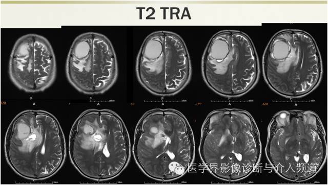 【病例】颅内转移瘤1例MR影像表现 【病例】颅内转移瘤1例MR影像表现