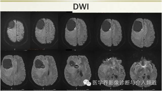 【病例】颅内转移瘤1例MR影像表现 【病例】颅内转移瘤1例MR影像表现