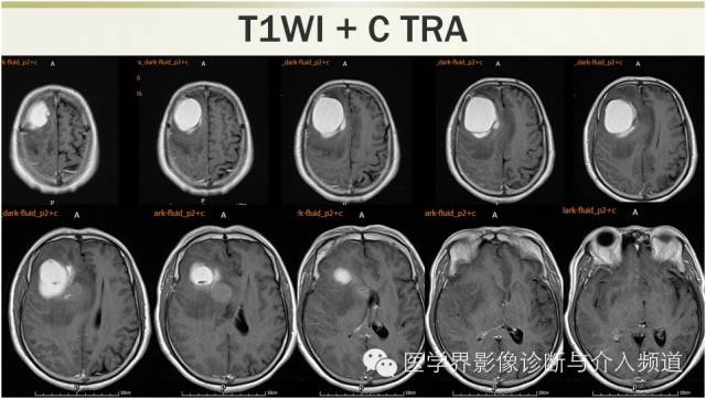 【病例】颅内转移瘤1例MR影像表现 【病例】颅内转移瘤1例MR影像表现