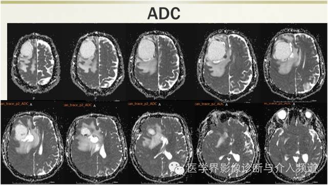 【病例】颅内转移瘤1例MR影像表现 【病例】颅内转移瘤1例MR影像表现